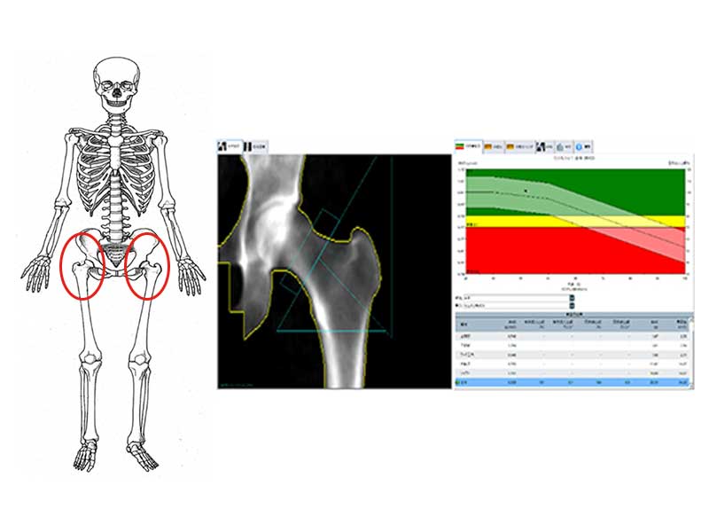 大腿骨を計測し、正確な診断、経過観察をおこないます。